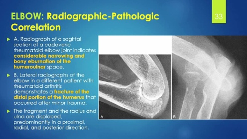 MSK Radiology from Kings College Rheumatoid Arthritis