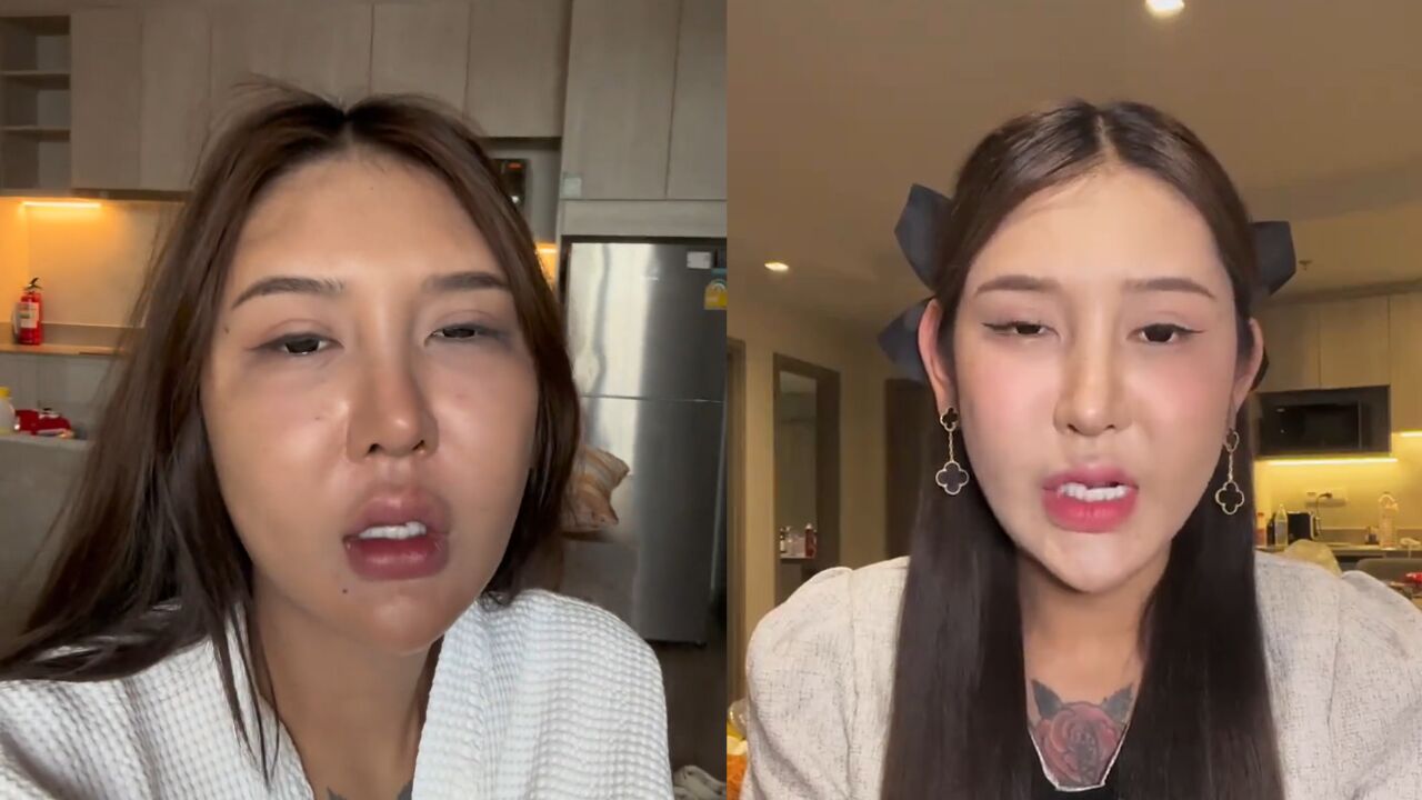 女子为丰臀打400支玻尿酸,致臀部感染:里面全是脓水,240万白花了