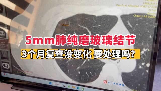 体检查出5mm纯磨玻璃结节,3个月复查没变化,究竟要不要手术?