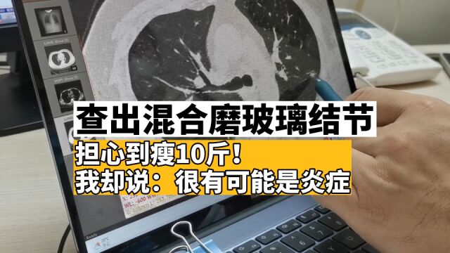 混合磨玻璃结节,担心到瘦了10斤!我告诉他:很有可能是炎症结节