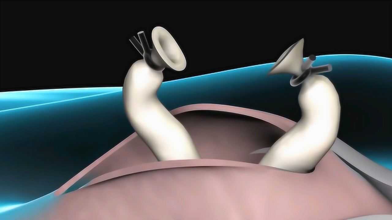 男性结扎手术对身体有什么危害吗3d动画记录全过程