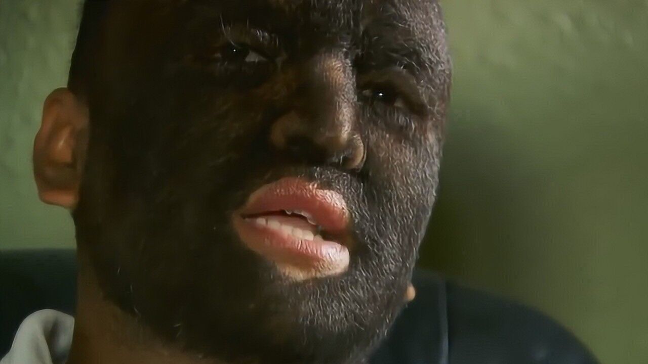 全世界毛发最多的人,全球只有50人,俗称狼人症!