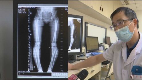 妙龄女O型腿，医生治疗巧用3D技术，模拟病变部位精确矫正计划