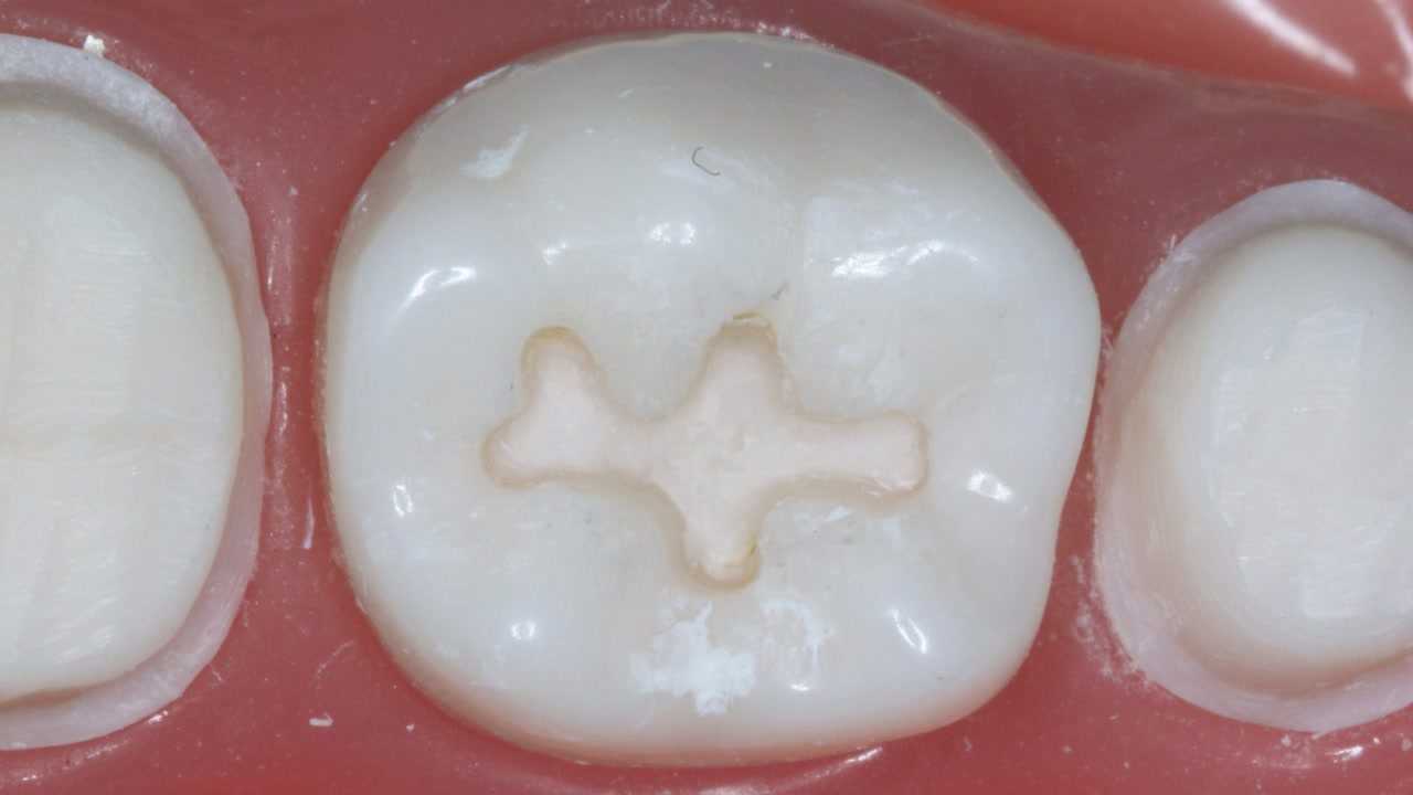 36仿真牙i类洞制备-牙体牙髓病学实验4-1