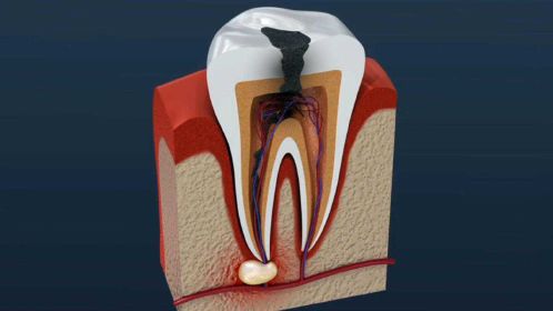 根管治療動畫演示你的牙神經就是這麼被抽出來的