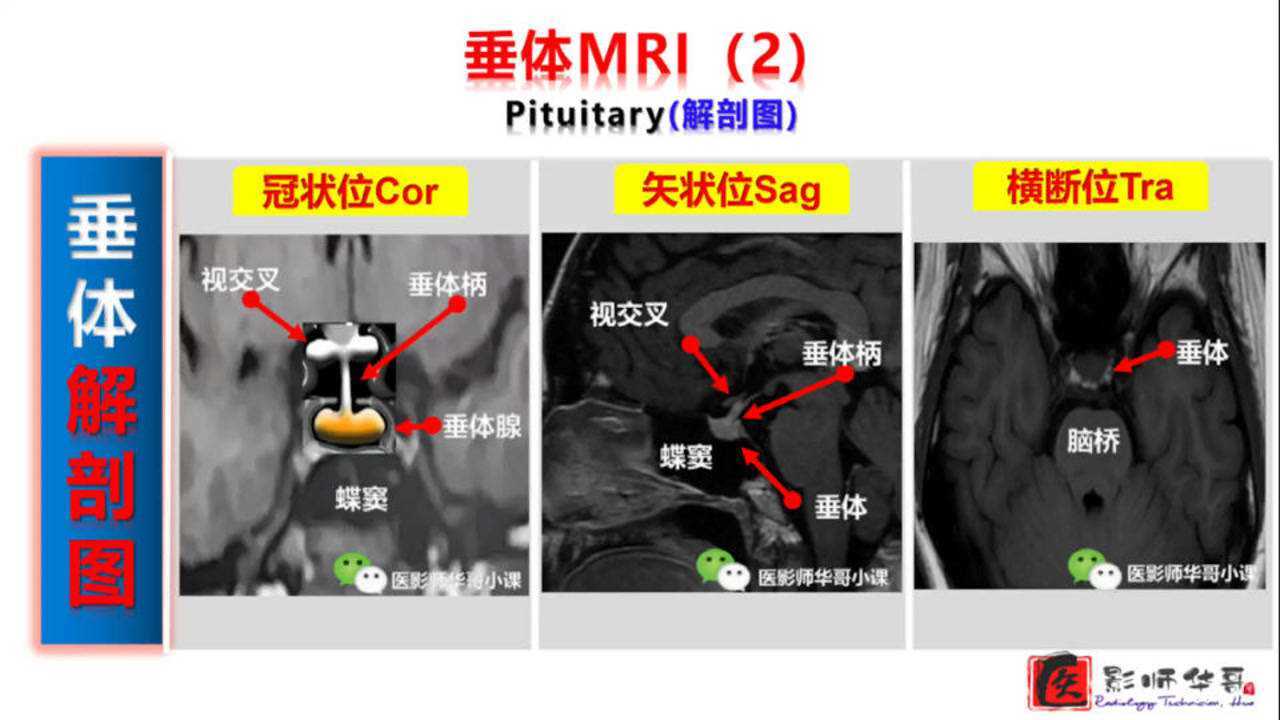 垂体磁共振MRI扫描定位_高清1080P在线观看平台_腾讯视频
