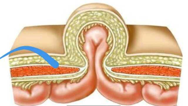 疝气患者血泪真实经历!带你领略最新治疗法!本人亲测有效!