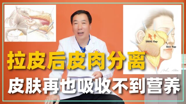 拉皮后皮肉分离了,皮肤再也吸收不到营养,之后老的更快吧?