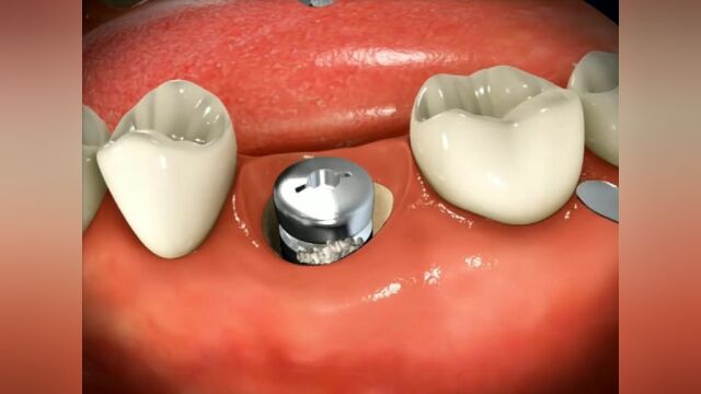 带你了解植牙全过程