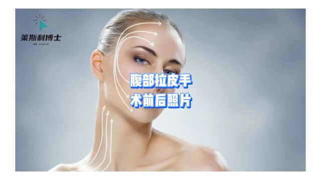 腹部拉皮手术前后照片?拉皮一般大概多少钱?