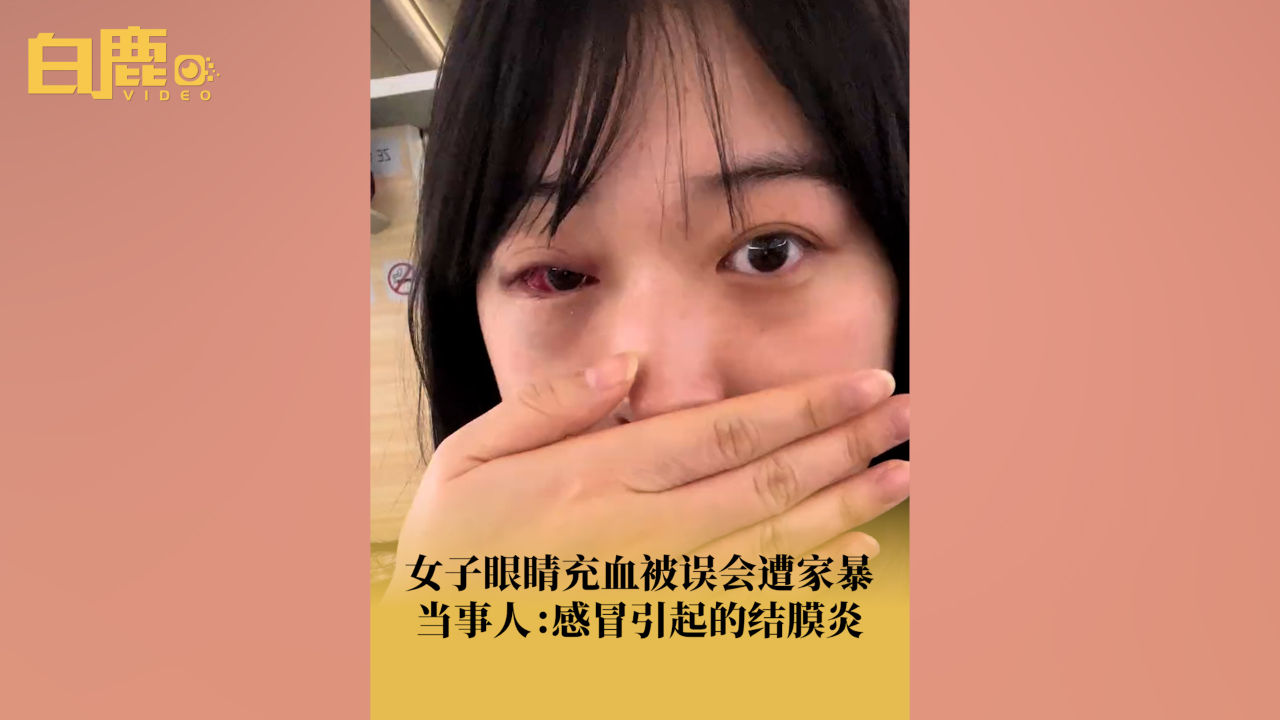女子感冒眼睛红肿被误会遭家暴