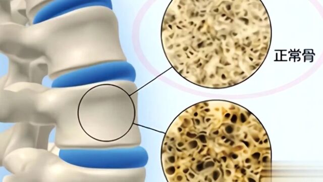 好可怕!一张图带你了解骨质疏松性骨折