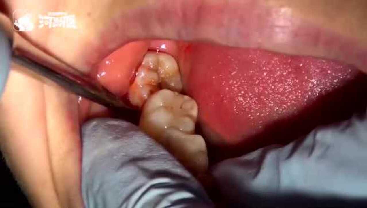 智齿拔除的全过程，看完已经整个人都不好了！_高清