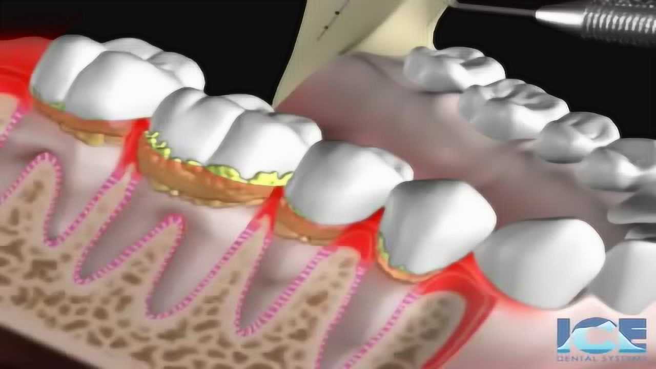 牙龈萎缩是怎么来的,这个视频让你看懂这一切!腾讯视频
