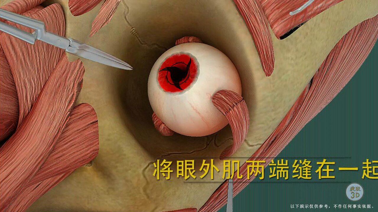 注視力不集中,斜視眼能治?3d演示斜視手術,記得咬牙也要看完_騰訊視頻