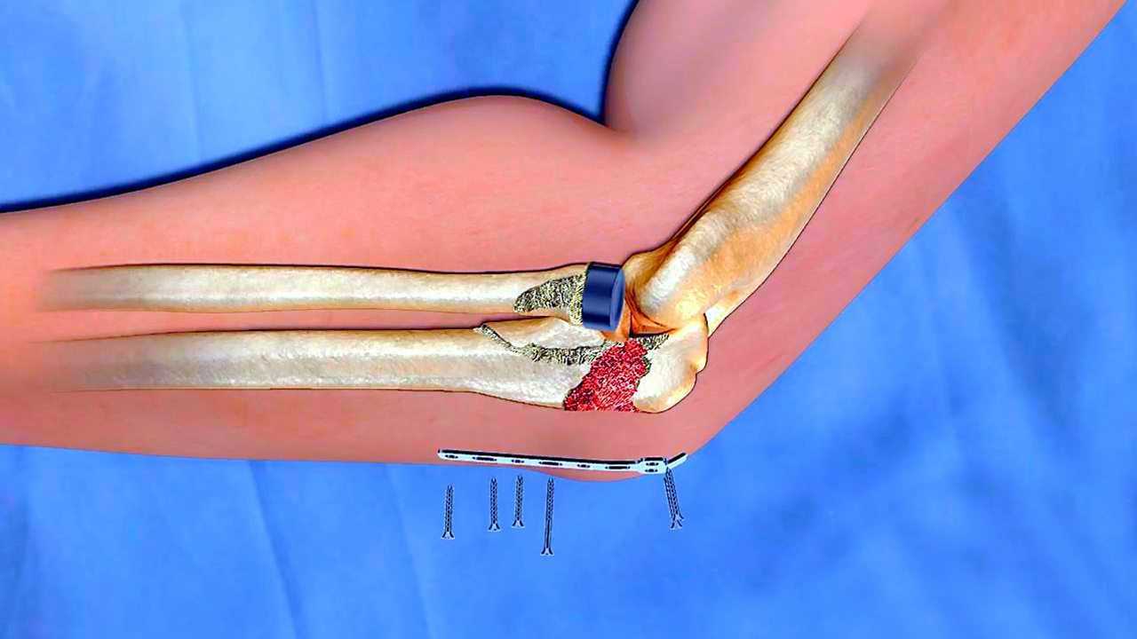 骨折后钢钉上在哪个位置3d动画让你看懂肘关节损伤手术的原理