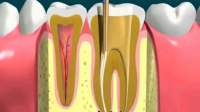 动画演示根管治疗全过程,打桩做牙冠!
