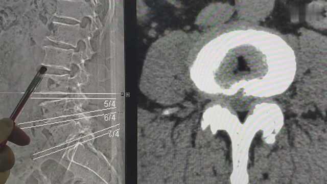 一位腰椎间盘严重突出+膨出的患者要求检查