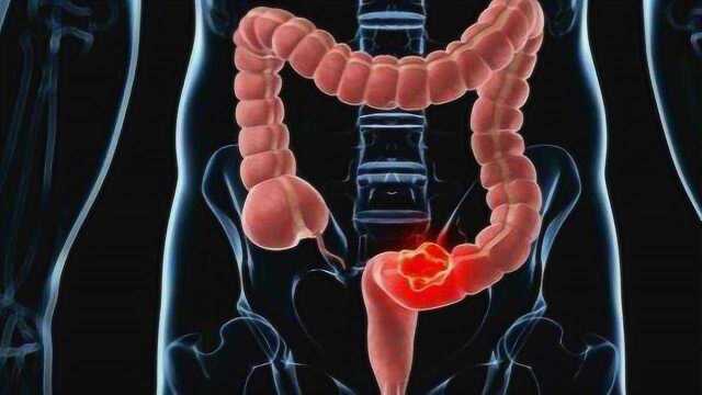 肠癌早期治疗生存率可达90%,肠癌的早期筛查意义重大!