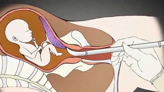 动画演示“打胎”全过程,手术场面极其残忍,让人头皮发麻!
