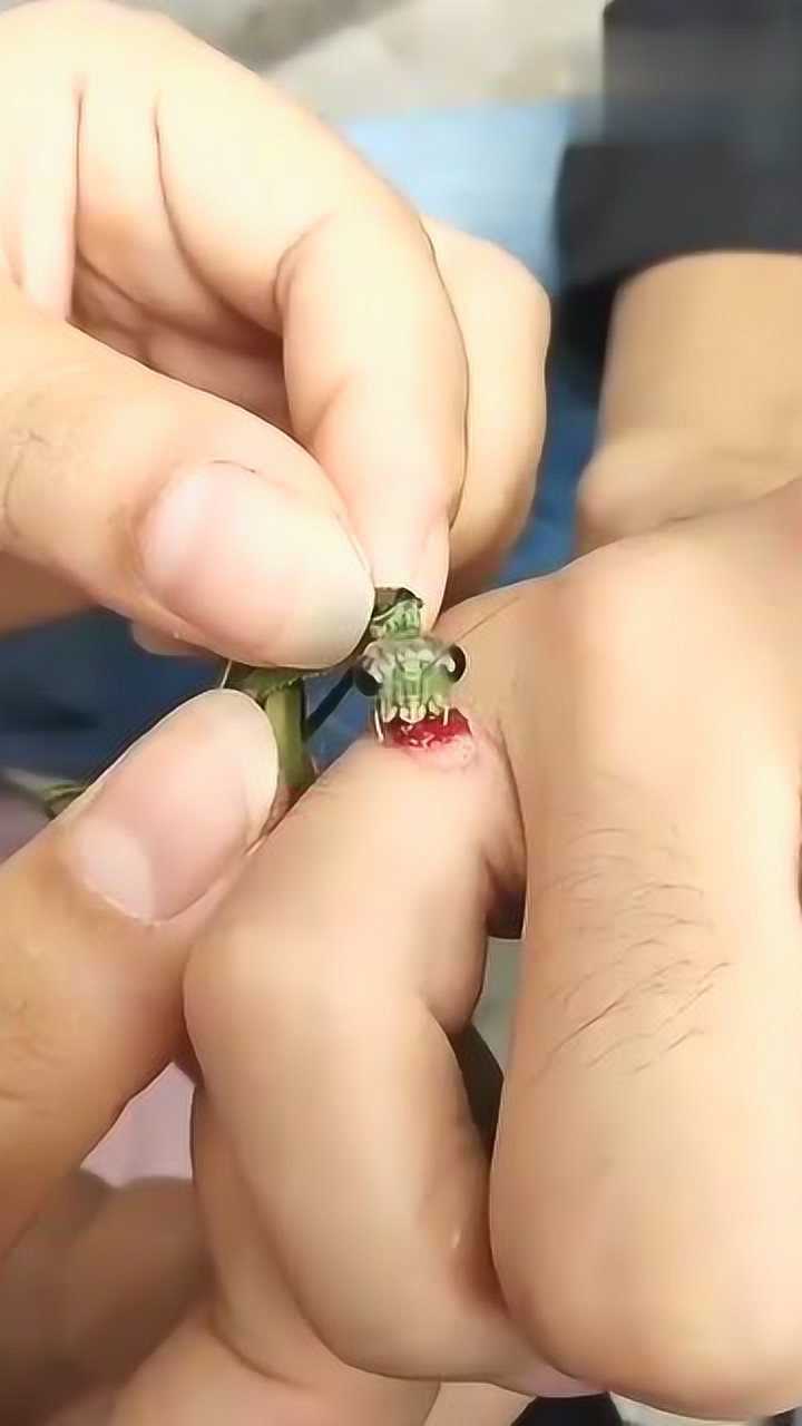 什么情况抓一只螳螂吃手上的瘊子
