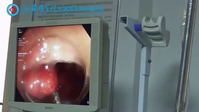 体检发现肠道内藏着3公分大的息肉惊恐万分 视频纪实 肠息肉切除术