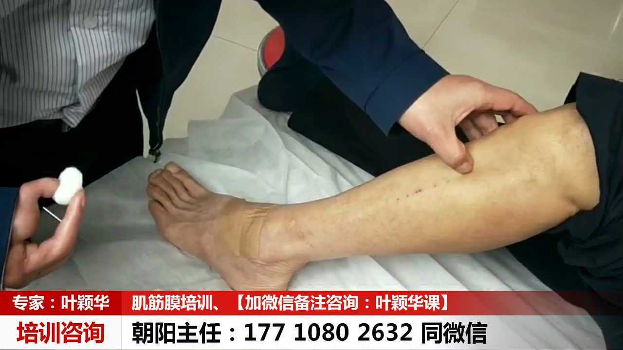 叶颖华肌筋膜治疗膝关节积液滑膜炎