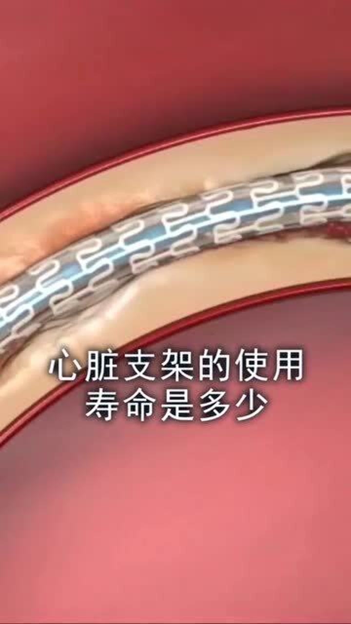 心脏支架的使用寿命是多少简直超乎我的想象啊长知识了