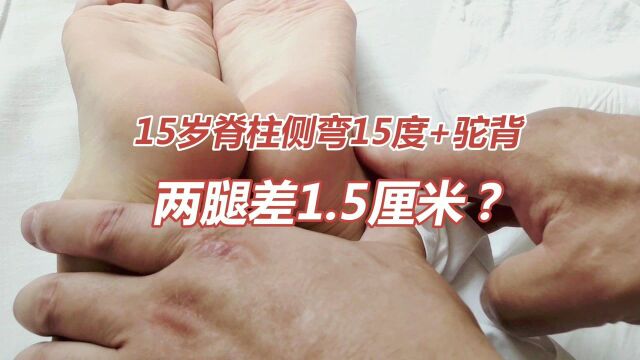 15岁女孩就脊柱侧弯、驼背,两腿还差1.5厘米