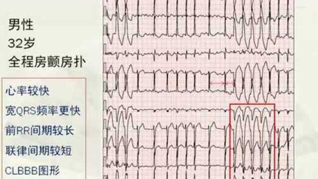 【心电视频】洪丽老师:房颤中的宽QRS辨析