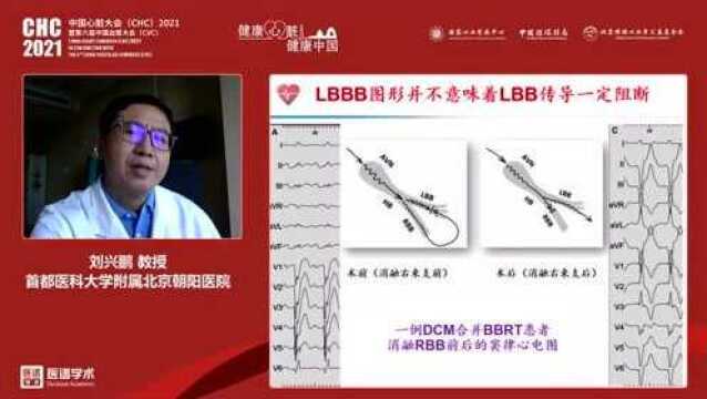 刘兴鹏教授:真性左束支传导阻滞的识别