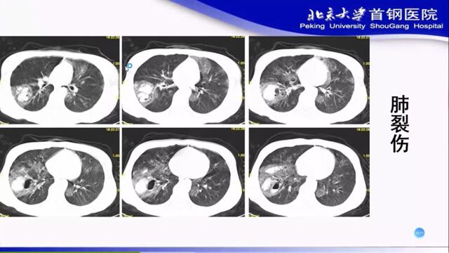 胸部创伤的CT诊断北京大学首钢医院杨帆