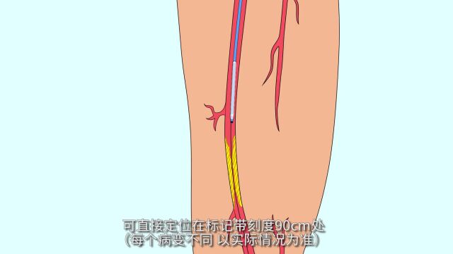 【问术ASK】陈世远教授团队:Rotarex机械血栓切除系统联合Ultraverse035标测球囊在下肢动脉闭塞症的应用病例分享