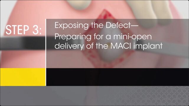 MACI surgical animation step 3 Exposing the defect