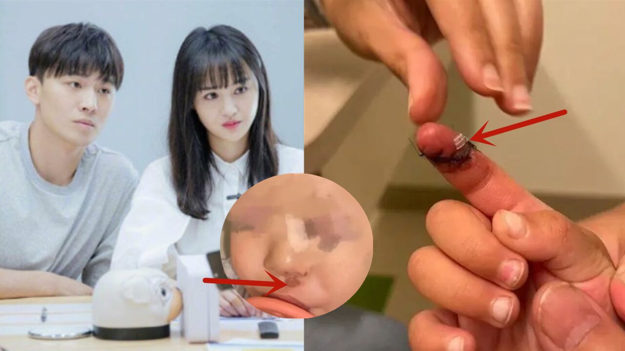 张恒落泪控诉郑爽虐童!俩孩子受伤照曝光触目惊心,哭着说害怕妈妈