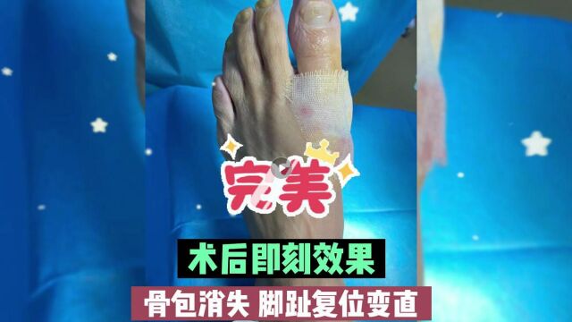 北京丰台广济带您了解大脚骨治疗效果