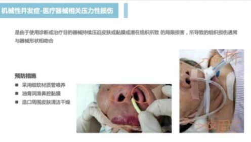 北京新起点医院-呼吸重症康复病房-202211鼻饲护理-邓亚迪