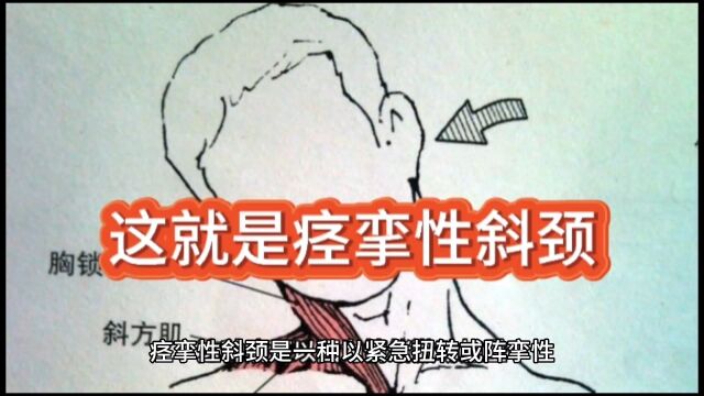 痉挛性斜颈是这样的