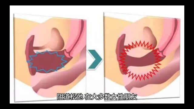 性生活频繁会导致阴道松弛?真实原因是…