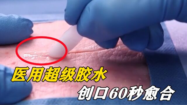 黑科技医用胶水是什么?涂在伤口上60秒愈合,原理你知道吗?