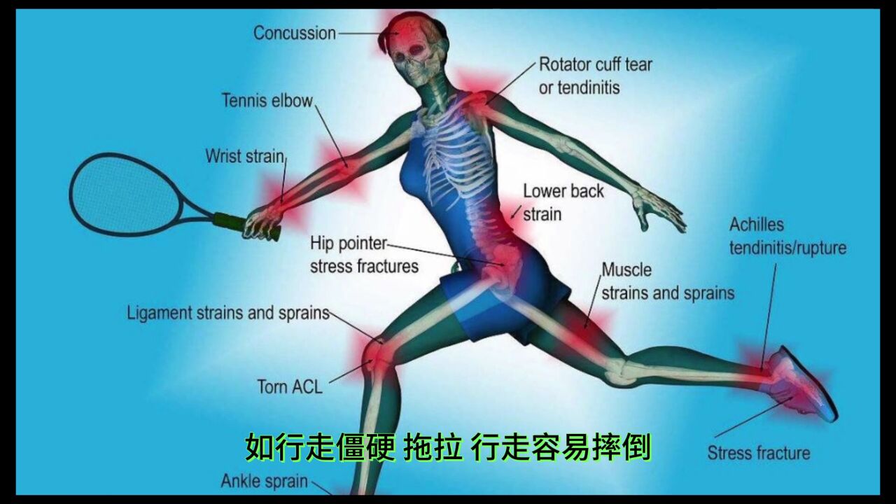运动神经元会导致肌肉萎缩吗?#运动神经元#康复训练#肌肉萎缩_高清1080P在线观看平台_腾讯视频