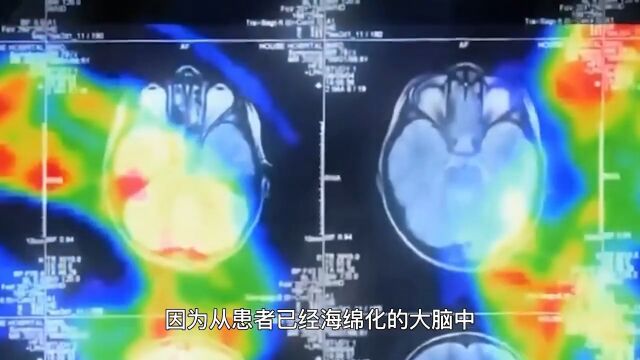 朊病毒1:真实存在的“丧尸病毒“,来源竟是同类相食?2023科普时刻