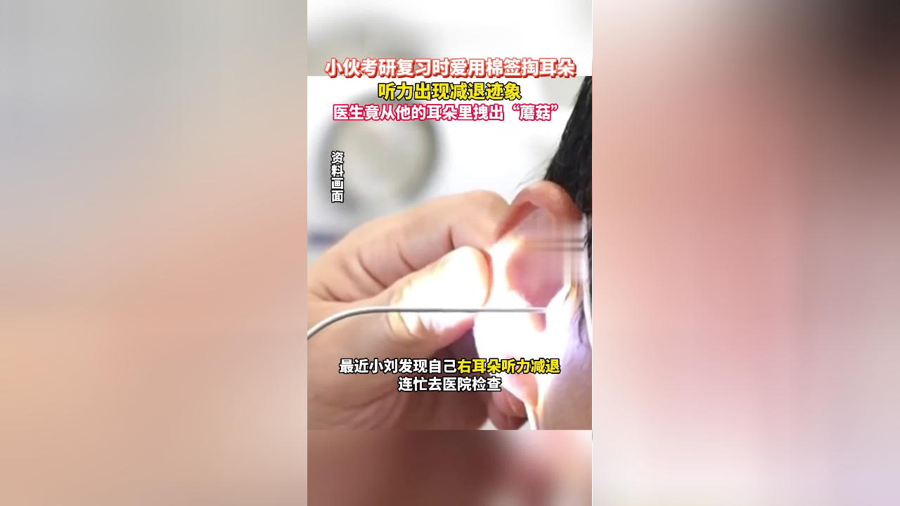 小夥考研複習時愛用棉籤掏耳朵聽力出現減退跡象醫生竟從他的耳朵裡拽