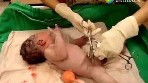 萌宝出生后母亲看不到的画面 宝宝脐带如何剪掉的？