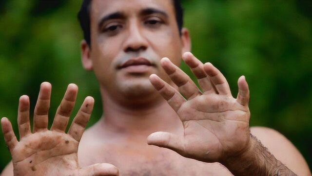 6根手指你见过但长成这样的你见过吗