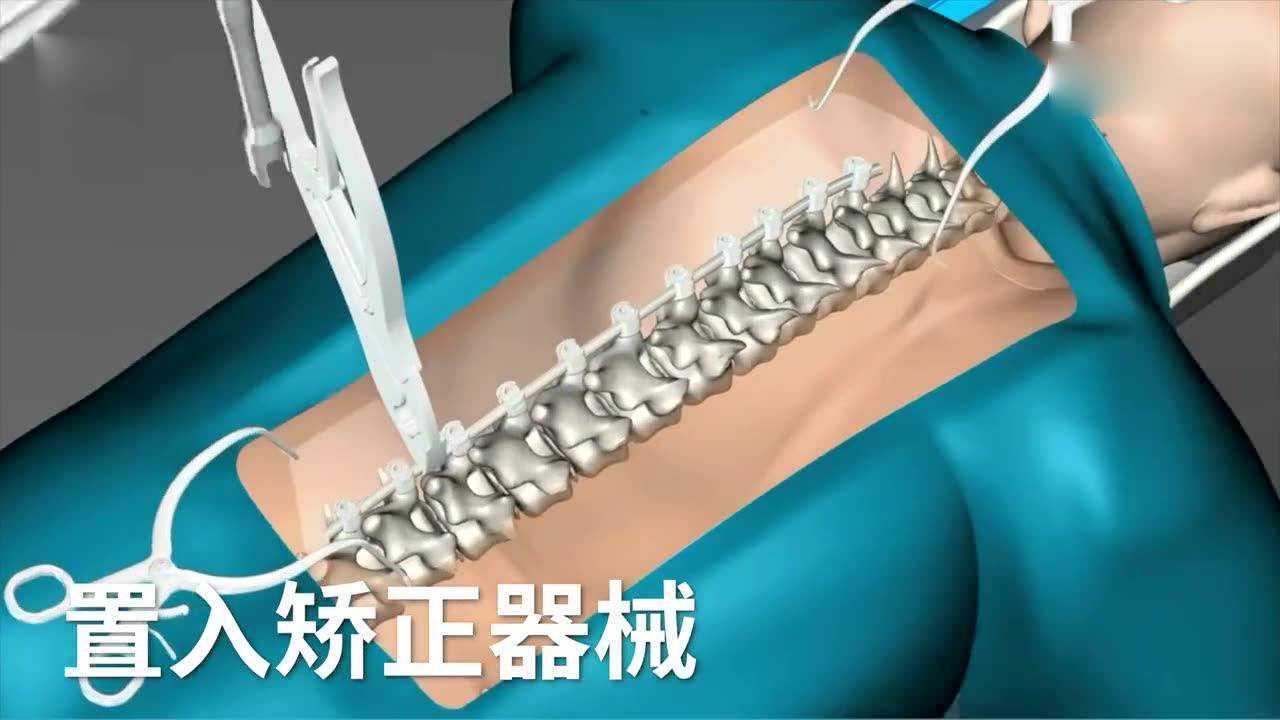 脊柱侧弯手术全过程让人触目惊心！_高清