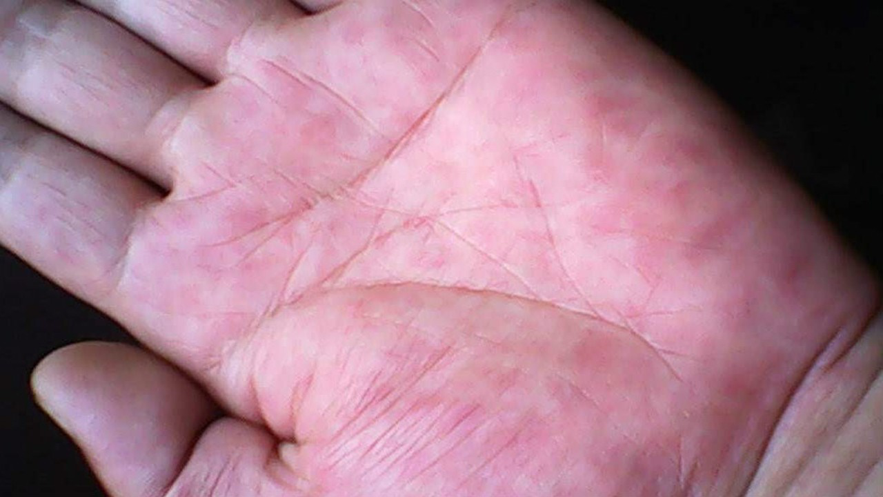 这种红肿号称"肝掌",是肝癌的征兆,你有这种症状吗?