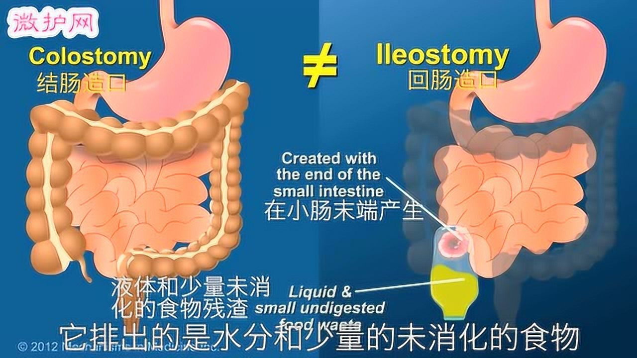 什么是回肠造口_高清