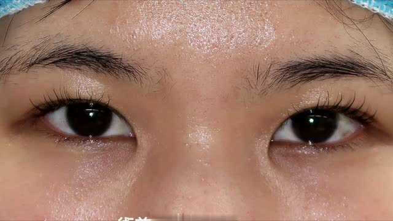 内眼角变大 竟然这么美