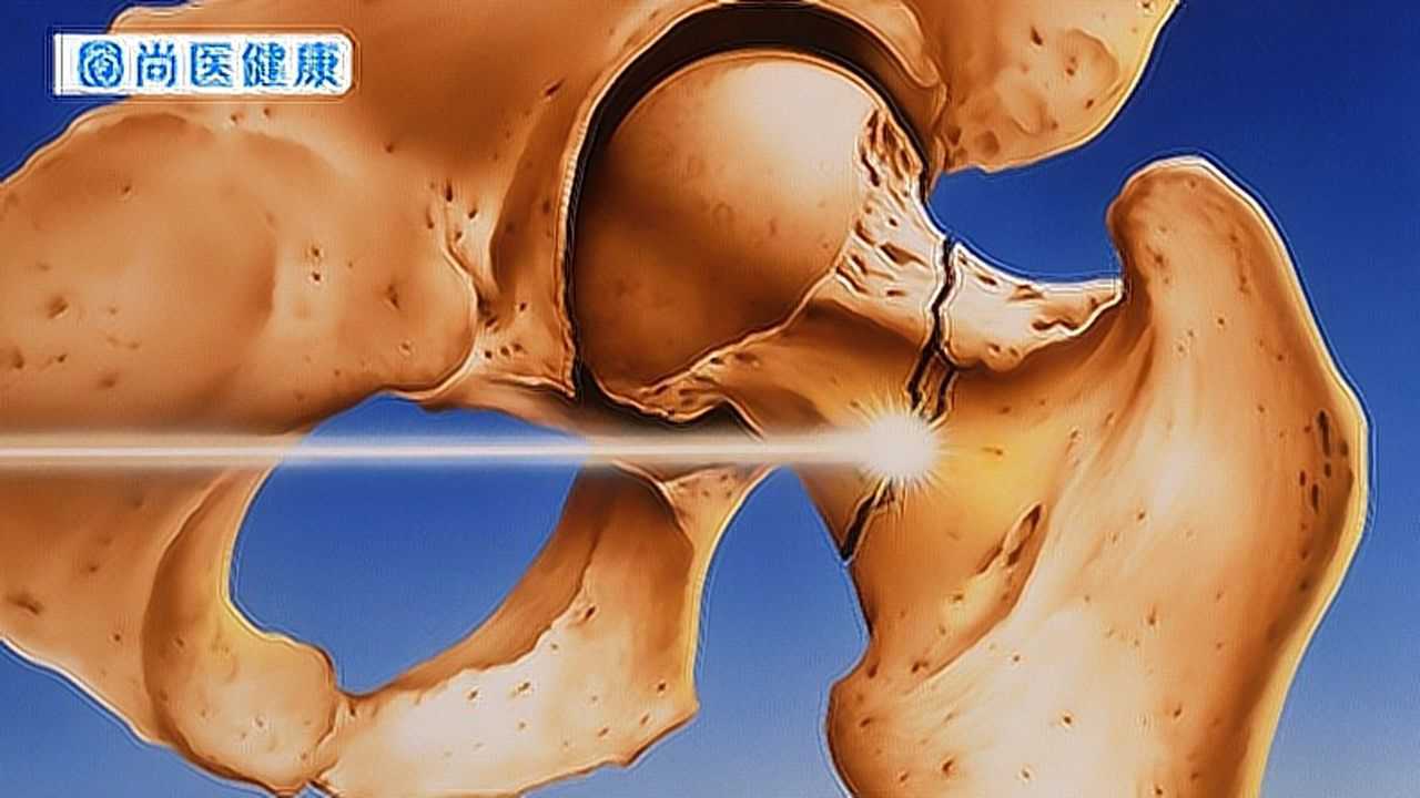 髋关节活动受限,疼痛,肿胀,发热,小心股骨头病!